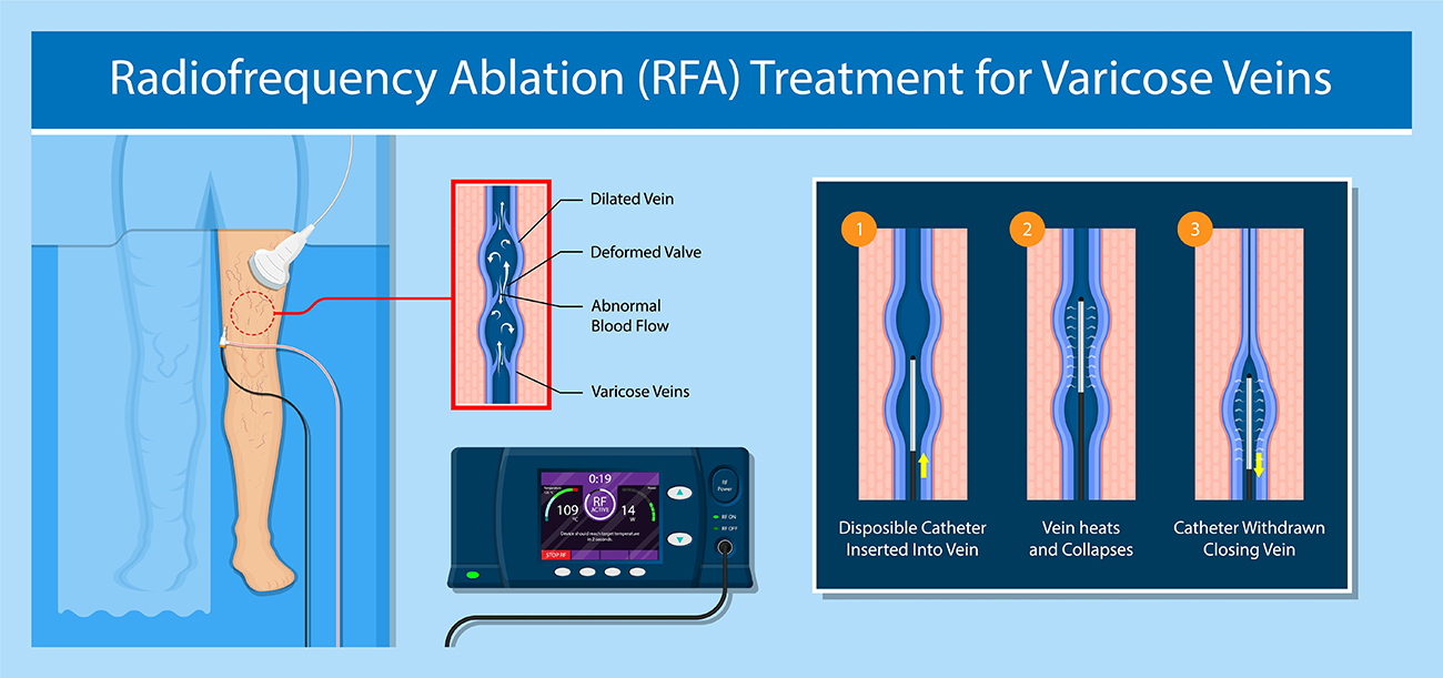 Radiofrequency Ablation New York Vein Treatment Center