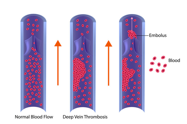Deep Vein Thrombosis Treatment Center in Manhattan, Brooklyn, and NYC