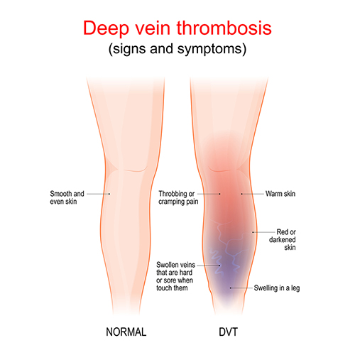 DVT signs and symptoms