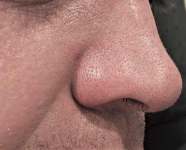 Face veins treatment