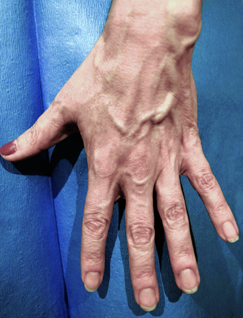 Spider veins in hands