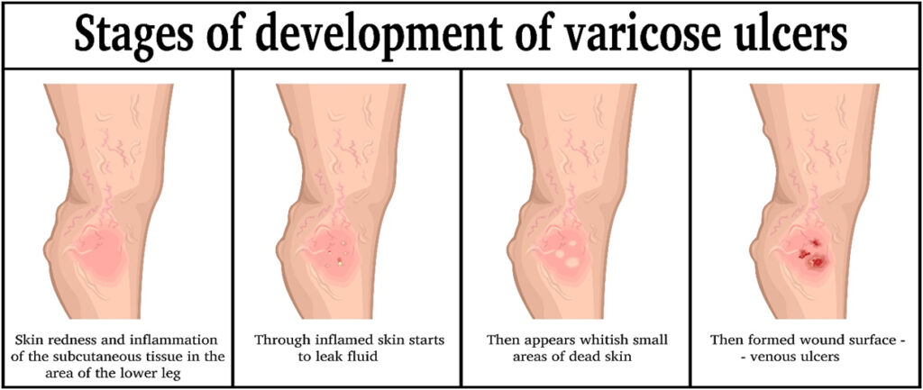 stages of varicose ulcers