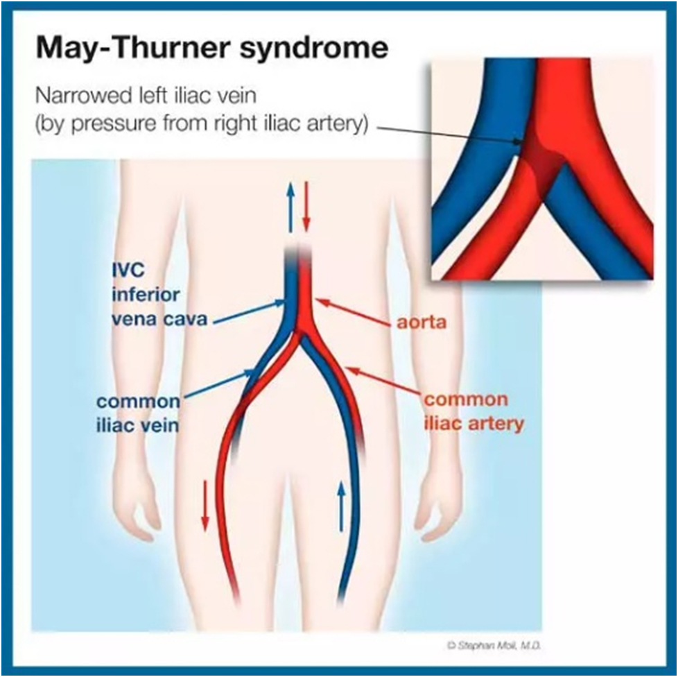 May Thurner Syndrome diagram