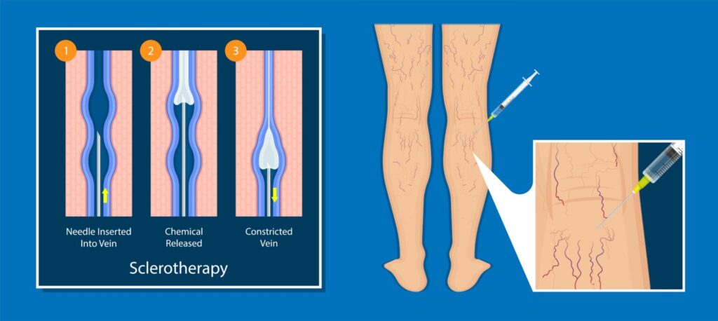 Sclerotherapy diagram