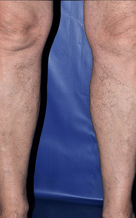Spider veins in legs