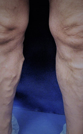 Spider veins in legs