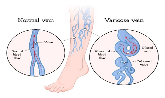 Normal vein vs Varicose vein