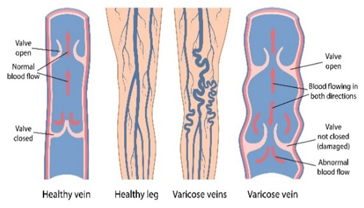 Healthy vein vs varicose vein diagram