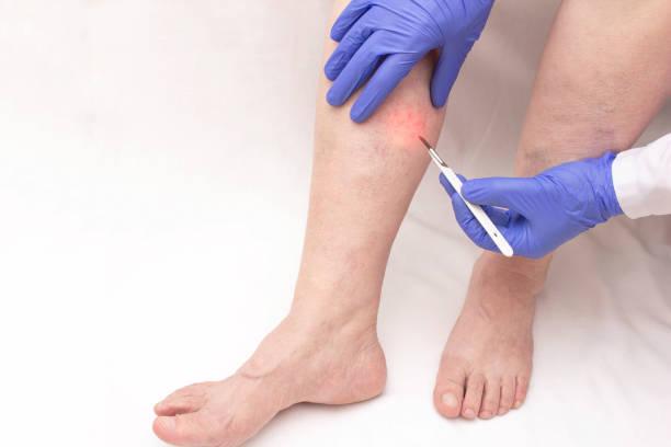 Sclerotherapy Treatment