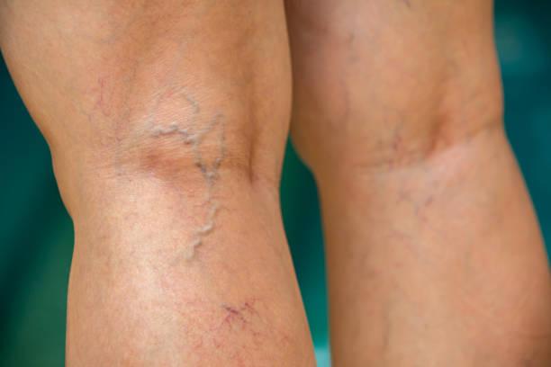 chronic venous in legs
